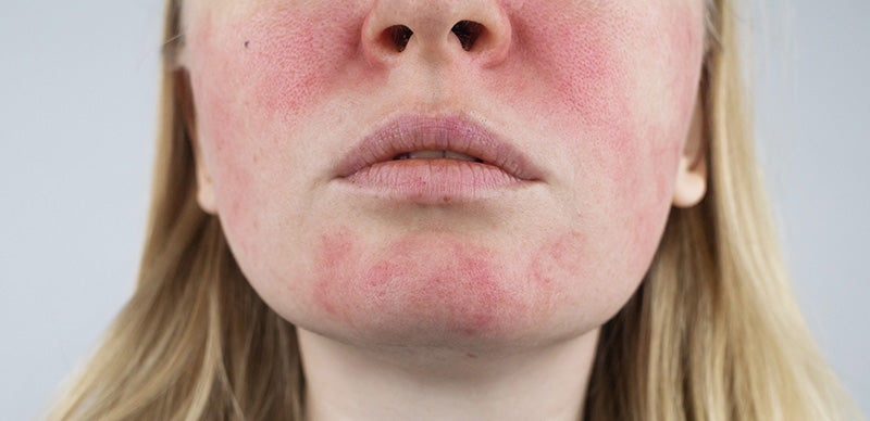 Understanding Rosacea: A Comprehensive Guide for Beginners
