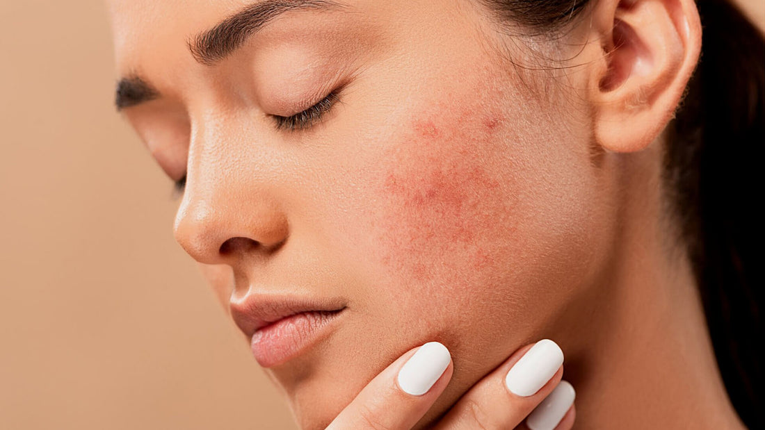 Demystifying Rosacea Triggers: Identifying and Managing Them