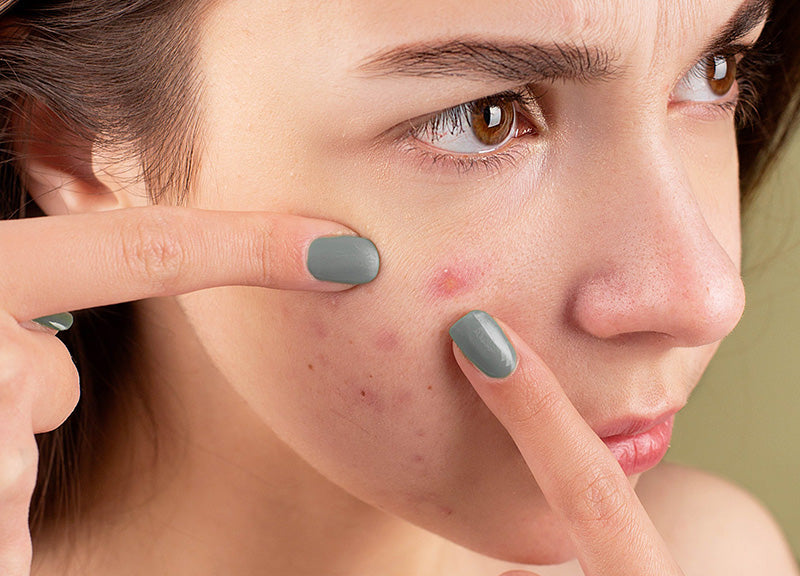 Busting Acne Myths: Separating Fact from Fiction