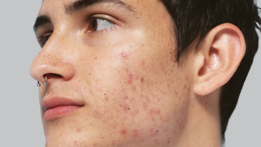 Battling Acne and Boosting Self-Esteem