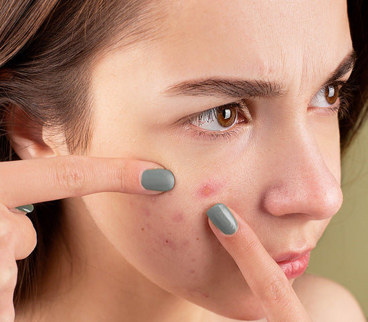 Skincare Routine for Teens: Battling Acne During Adolescence